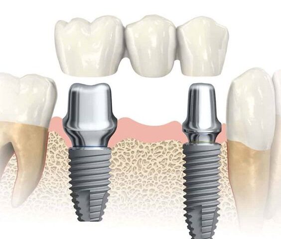 Tooth Extraction Procedure: What to Know About It?