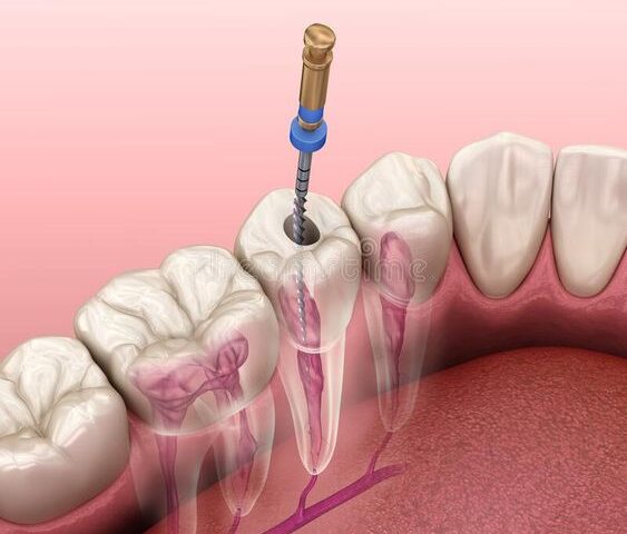 Récupération Après Extraction Dentaire: Guide Complet Pas à Pas